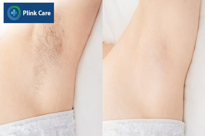 triệt lông nách vĩnh viễn có mọc lại không