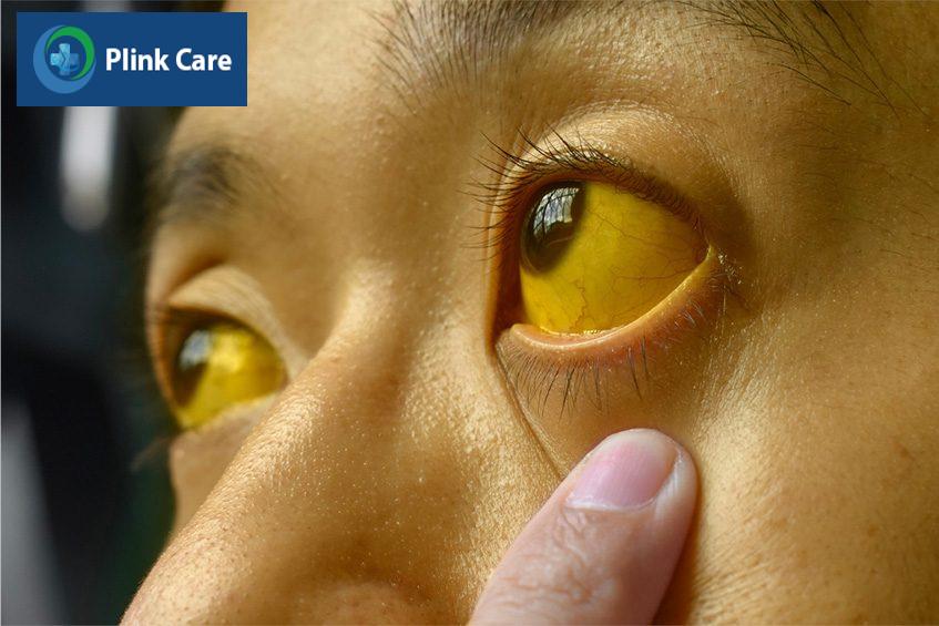 triệu chứng tắc ống mật