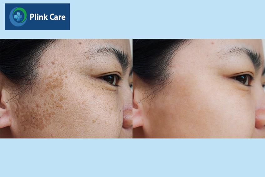 trước và sau khi điều trị nám bằng laser