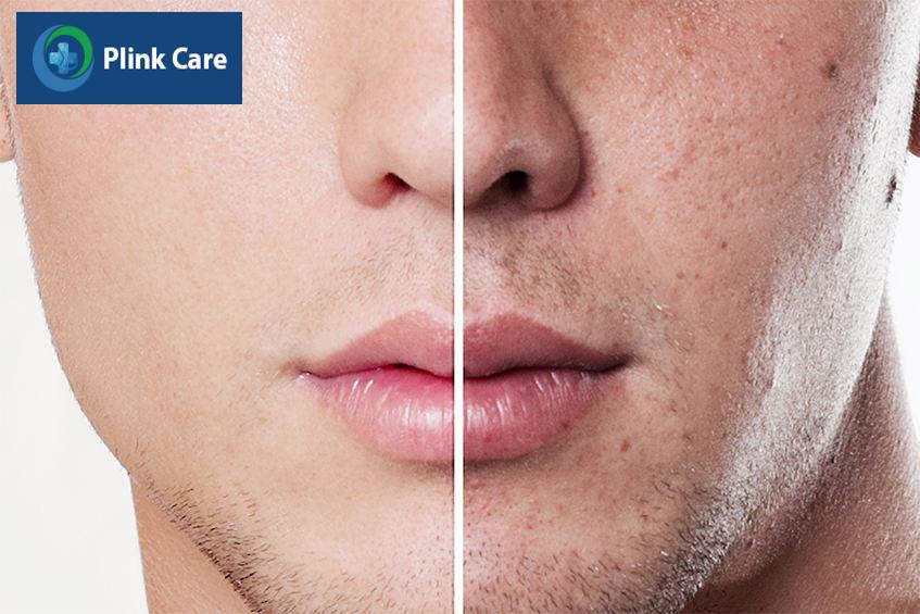 trước và sau khi triệt râu