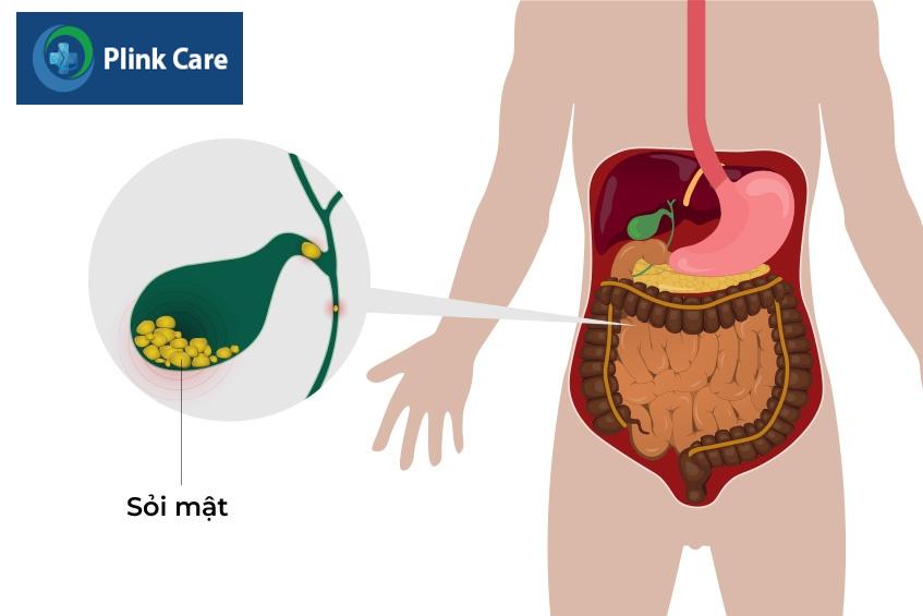 vàng da do tắc mật