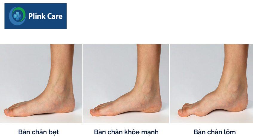 Bàn chân bẹt bàn chân lõm