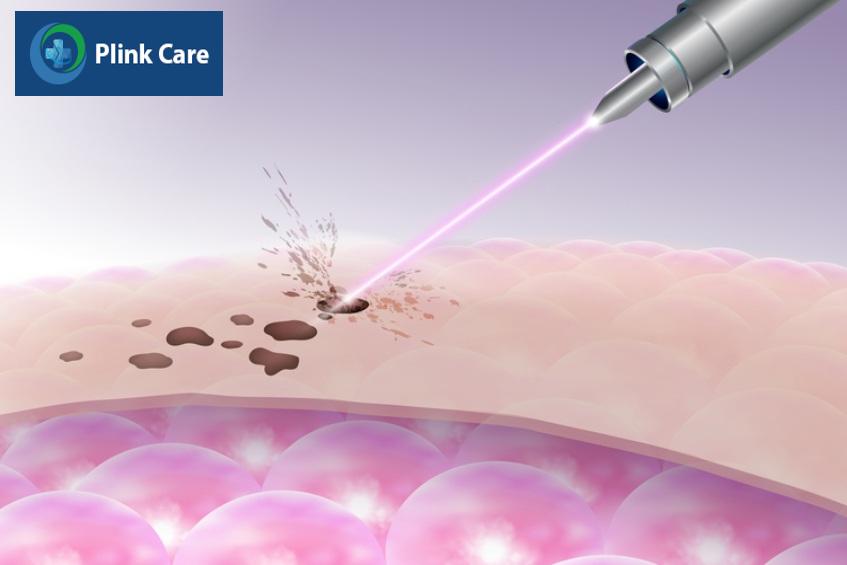 bắn laser trị tàn nhang