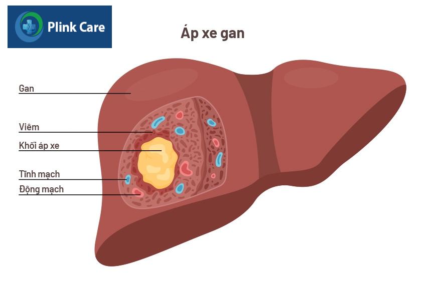bệnh áp xe gan