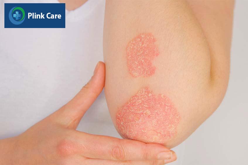 bệnh viêm khớp do vảy nến