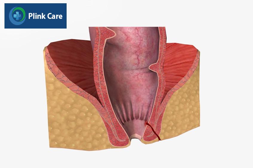 bị hẹp hậu môn sau phẫu thuật trĩ