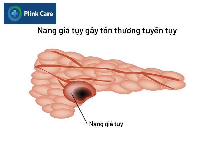 bị nang giả tụy