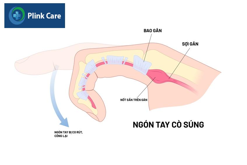 Các cấp độ bệnh ngón tay cò súng ở trẻ