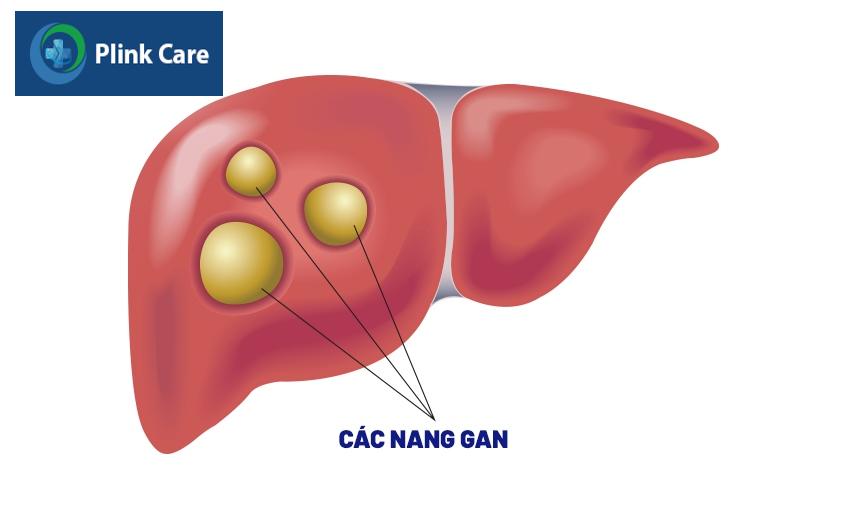 các nang ở gan