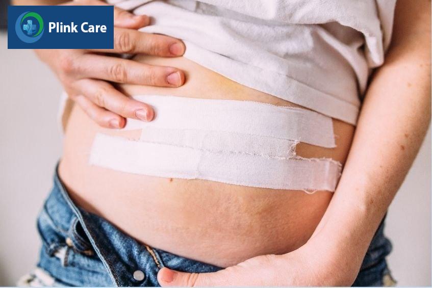 chăm sóc sau mổ thoát vị thành bụng