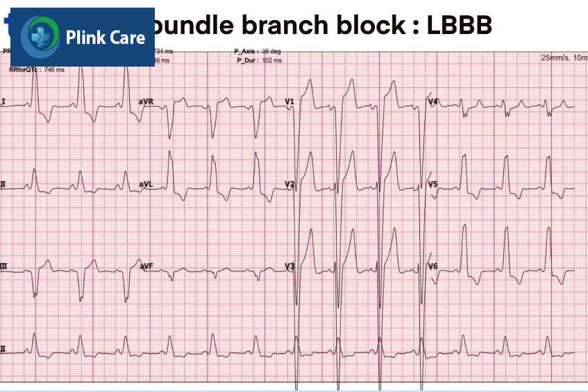 Chẩn đoán block nhánh trái thông qua kết quả điện tâm đồ
