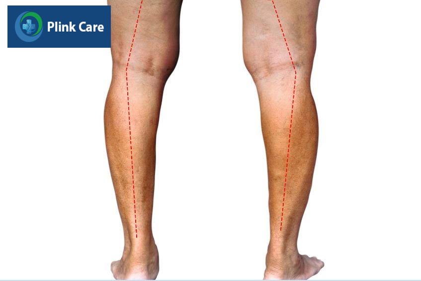 chân khuỳnh gây nhiểu vấn đề cho sức khỏe