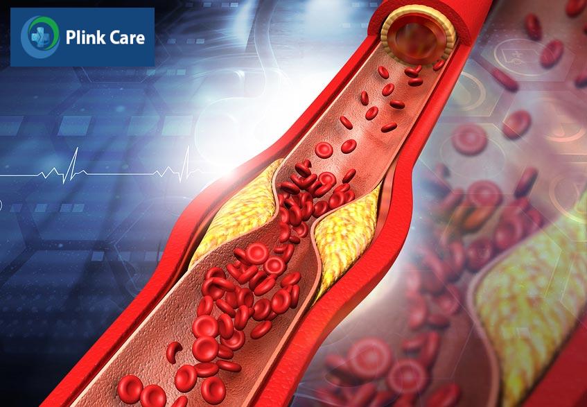 Cholesterol total cao gây tích tụ mảng bám ở động mạch