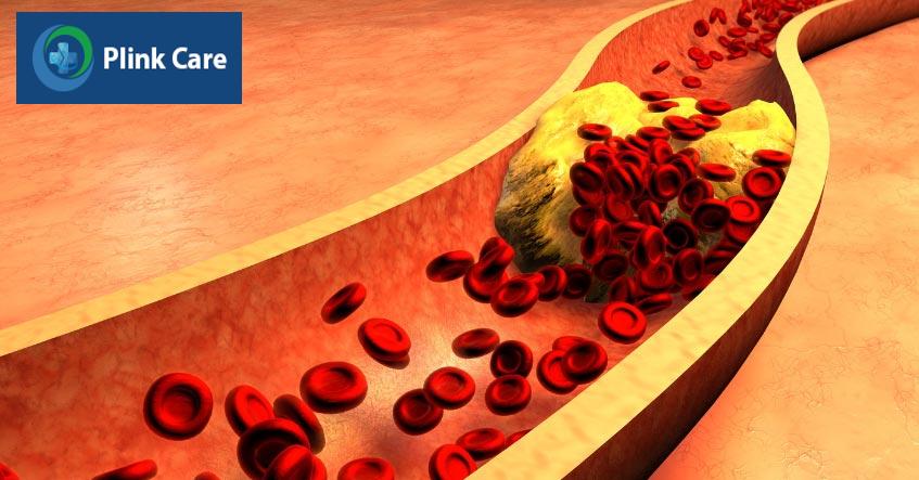 Cholesterol tích tụ tạo thành mảng bám gây tắc nghẽn động mạch vành