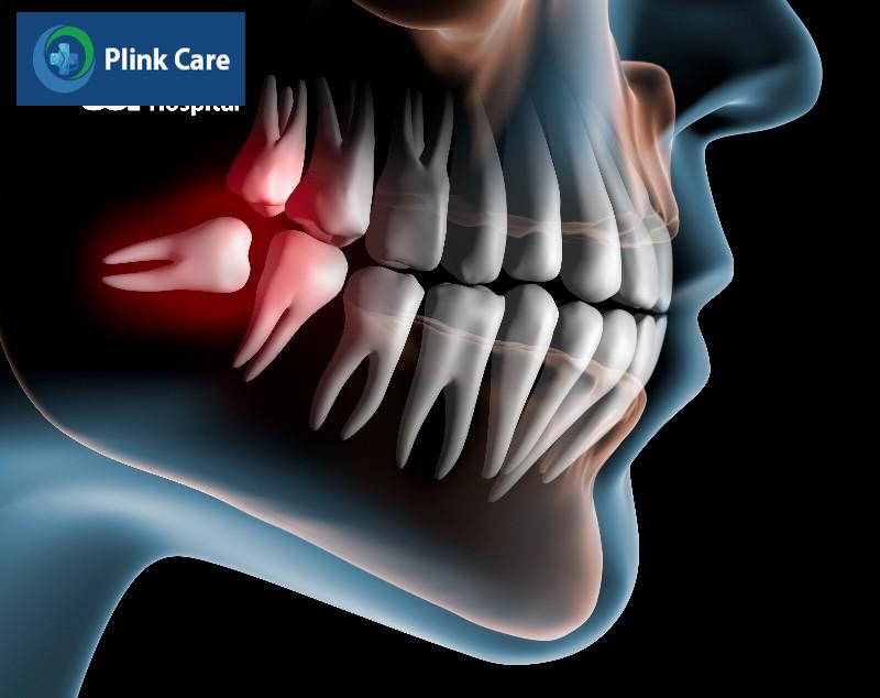 Có nên nhổ răng số 8 hàm dưới không?