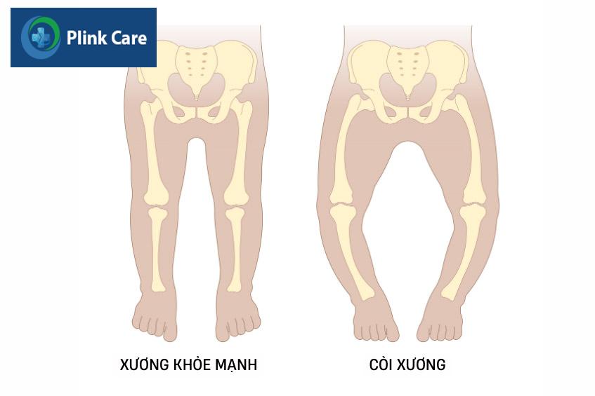 còi xương là một trong những nguyên nhân gây bệnh