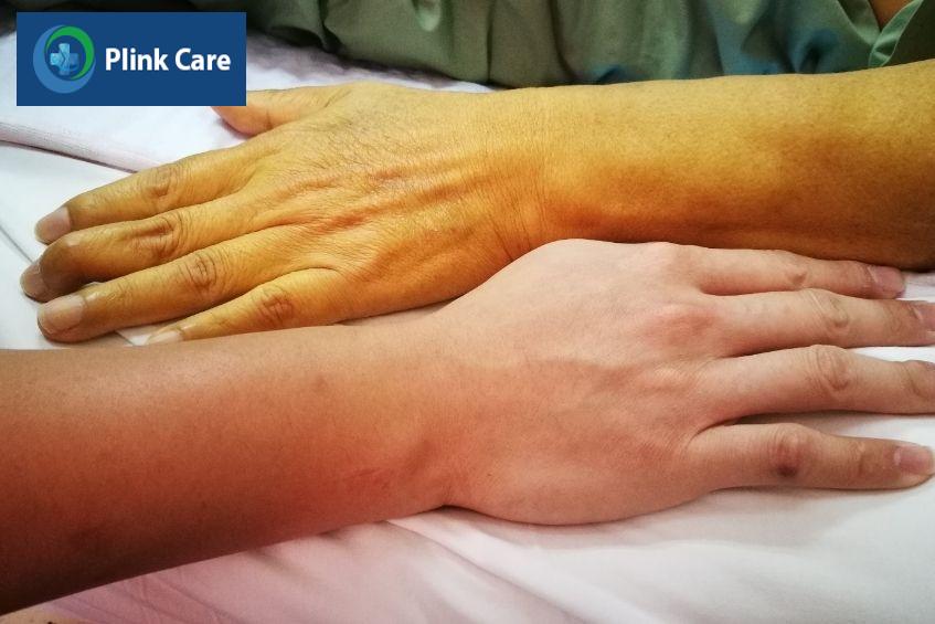 dấu hiệu chức năng gan suy giảm