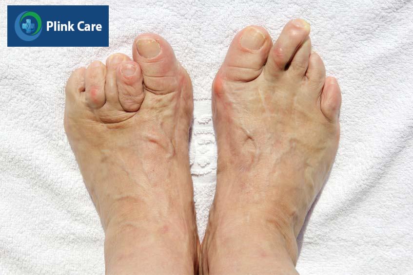 Dị tật bàn chân co rút không thể đi lại