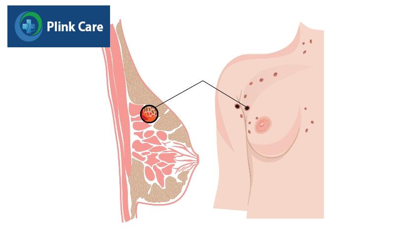điều trị her2 dương tính