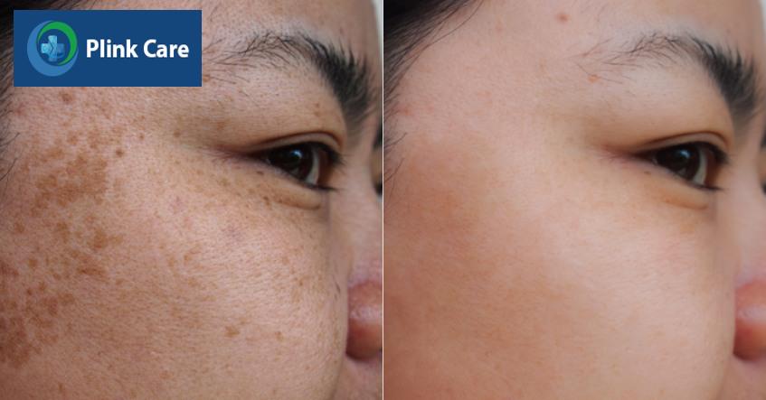 điều trị tàn nhang bằng kem cần kiên trì