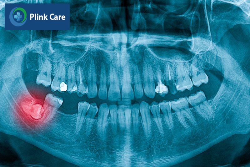 Mọc răng khôn đau mấy ngày mới hết?