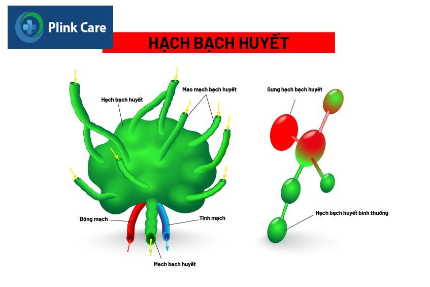 Hạch bạch huyết bình thường và hạch bạch huyết bị sưng