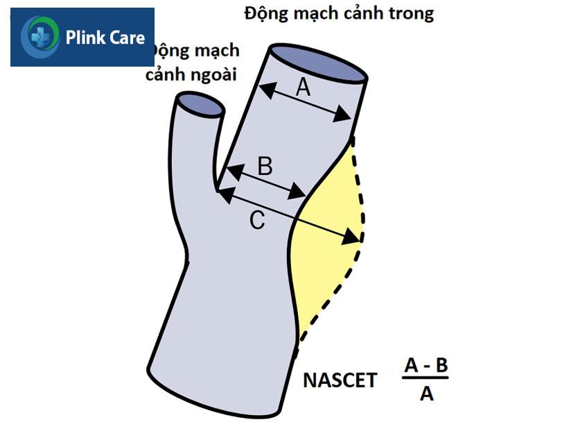 Hẹp động mạch cảnh càng nặng sẽ ảnh hưởng đến chi phí đặt stent mạch cảnh