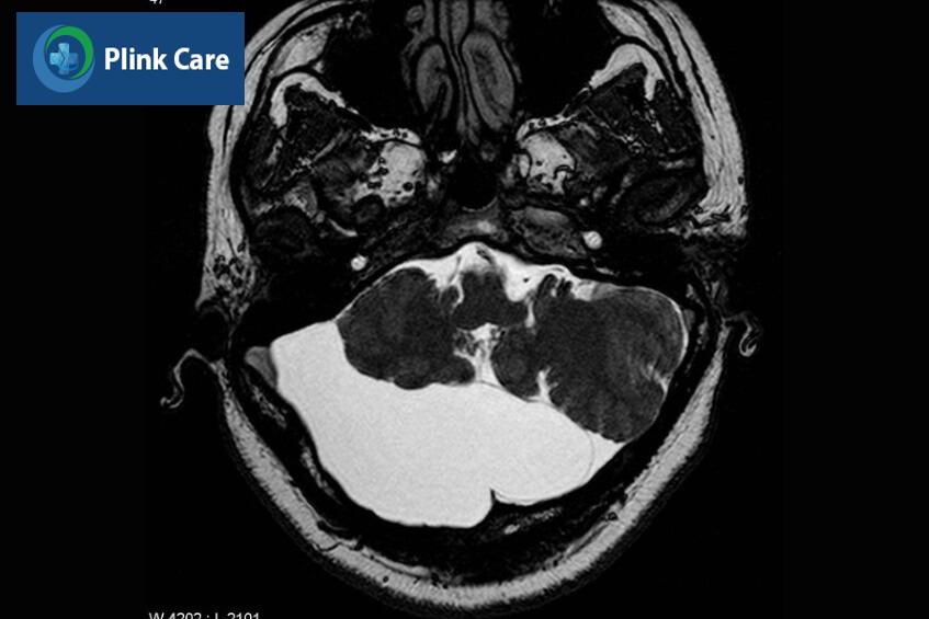 hình ảnh mri nang màng nhện nguy hiểm 