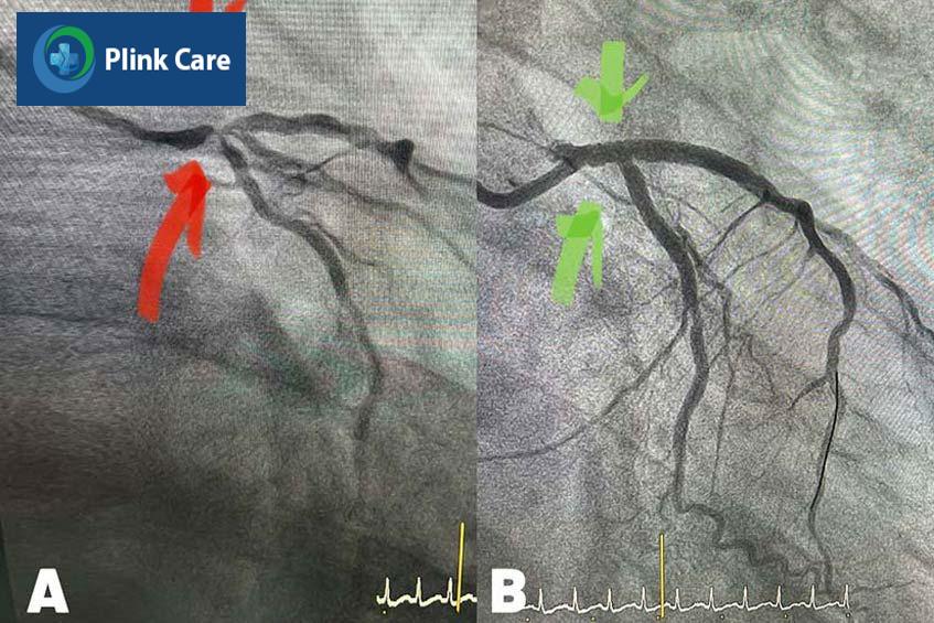 Hình ảnh trước (hình A) và sau khi đặt hai stent (hình B)