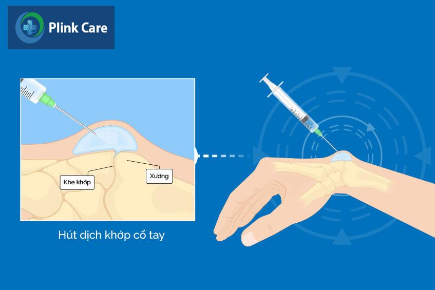 hút dịch và tiêm khớp giúp điều trị hiệu quả