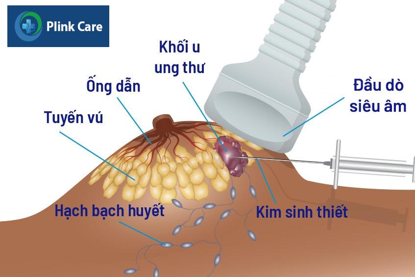 khối u ở ngực