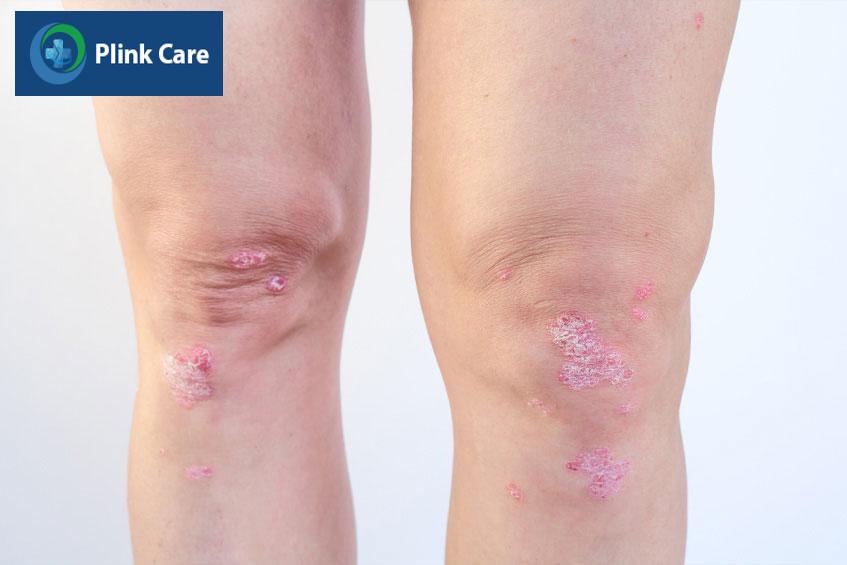 khớp gối tràn dịch do nhiều nguyên nhân khác nhau