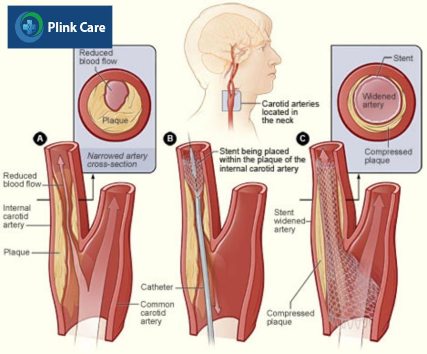 Kỹ thuật đặt stent động mạch cảnh