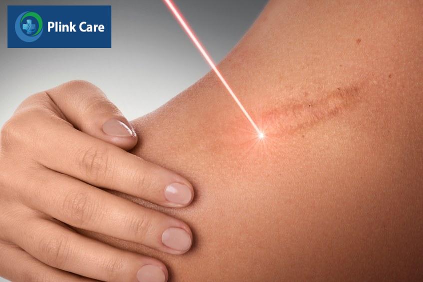 liệu pháp laser có thể làm mờ sẹo