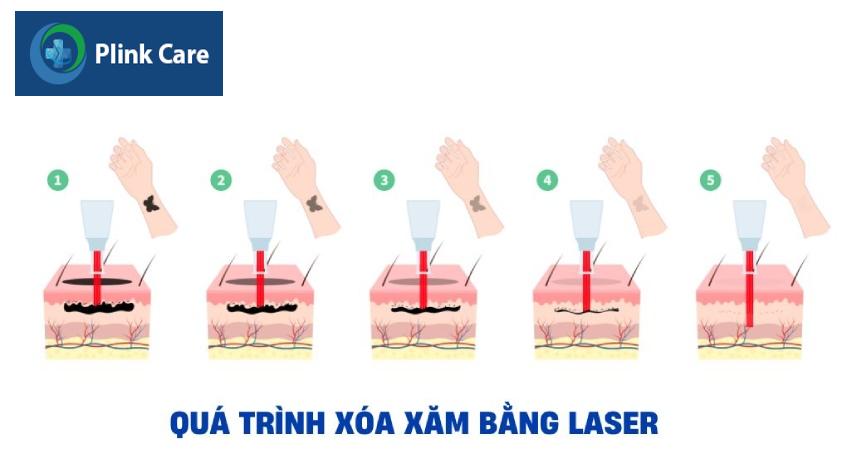 liệu trình xoá xăm bằng laser