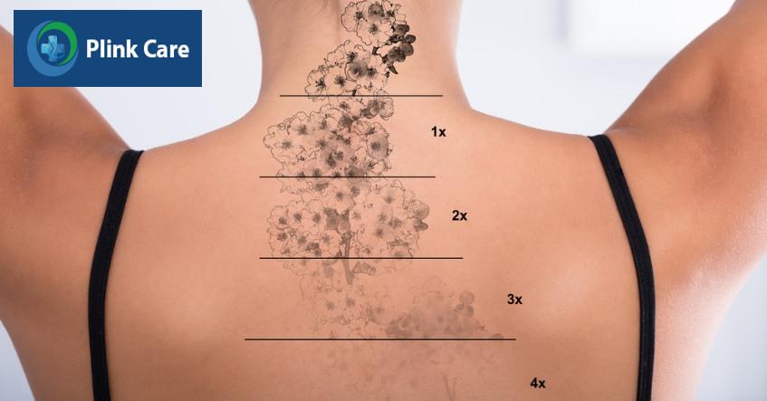 liệu trình xóa xăm kéo dài bao lâu