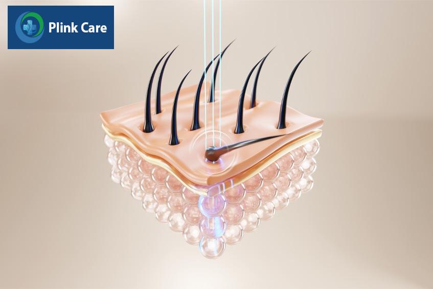 lợi ích khi lựa chọn triệt lông vĩnh viễn