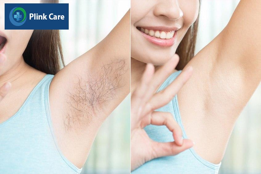 lưu ý khi lựa chọn triệt lông