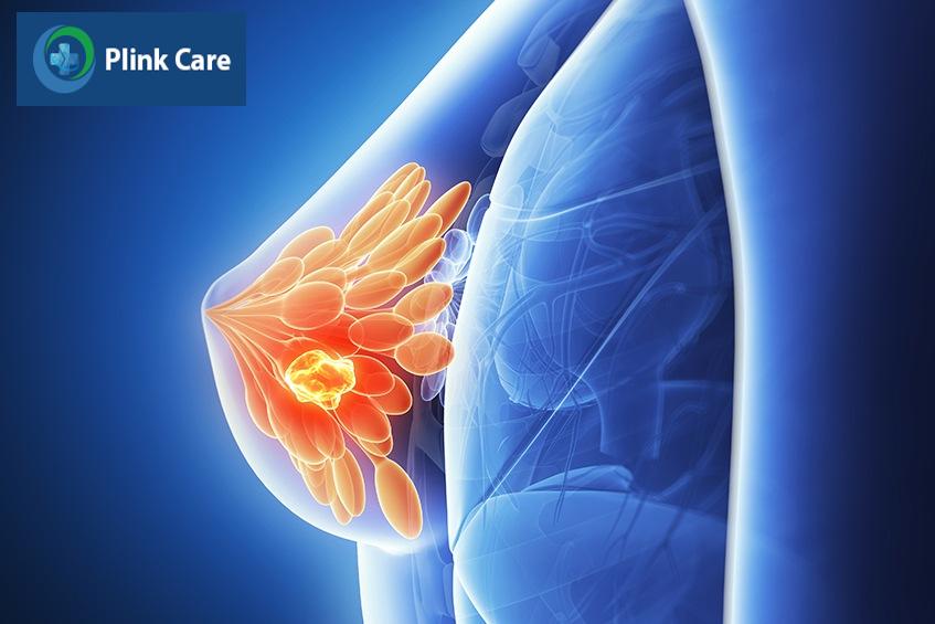 mắc ung thư vú bạn nên hỏi gì