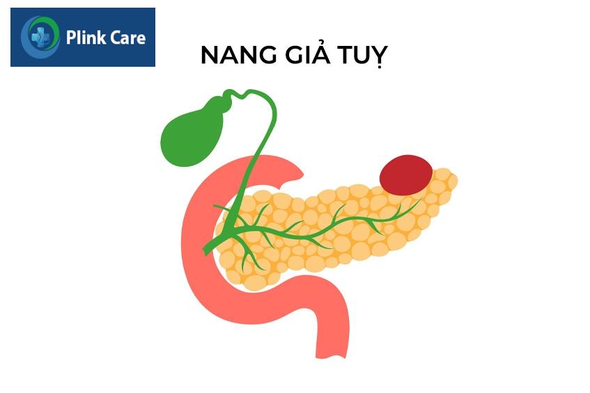 nang giả tụy là gì