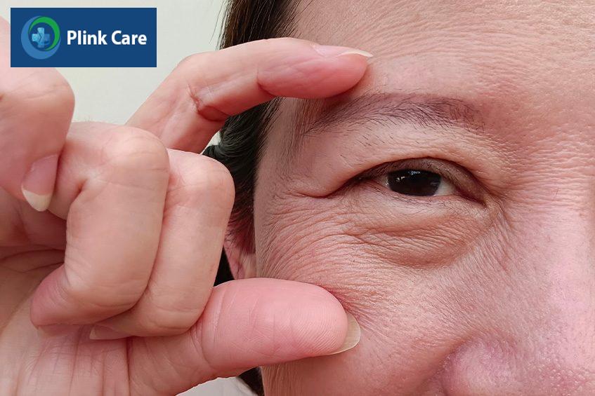 nếp nhăn quanh mắt có xóa được không