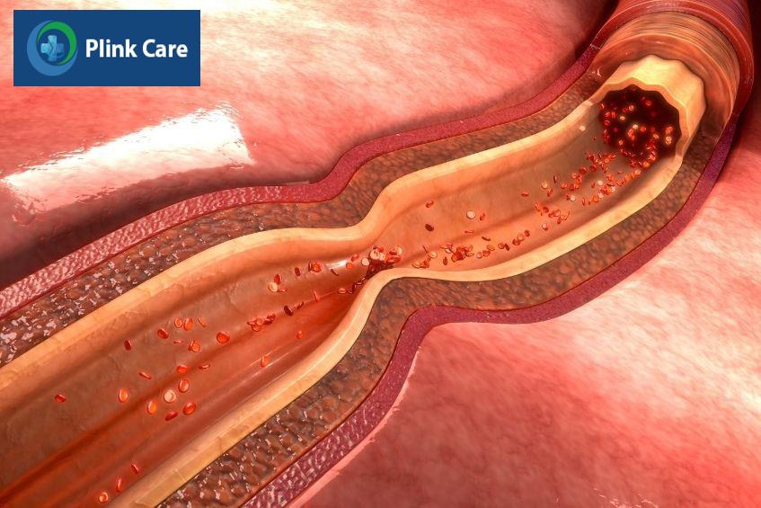 Nguyên nhân nhồi máu cơ tim thường gặp do tắc nghẽn động mạch vành