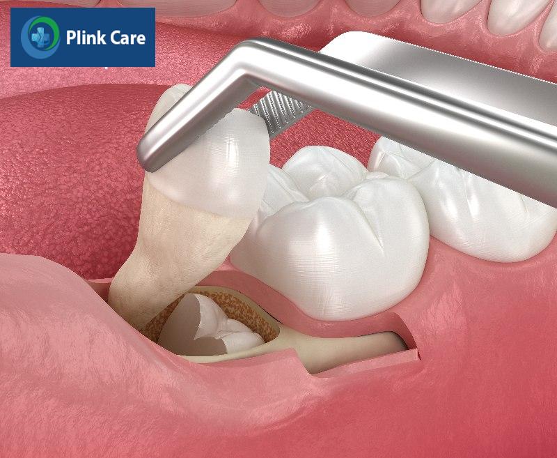 Nhổ răng khôn hàm dưới bằng phương pháp truyền thống