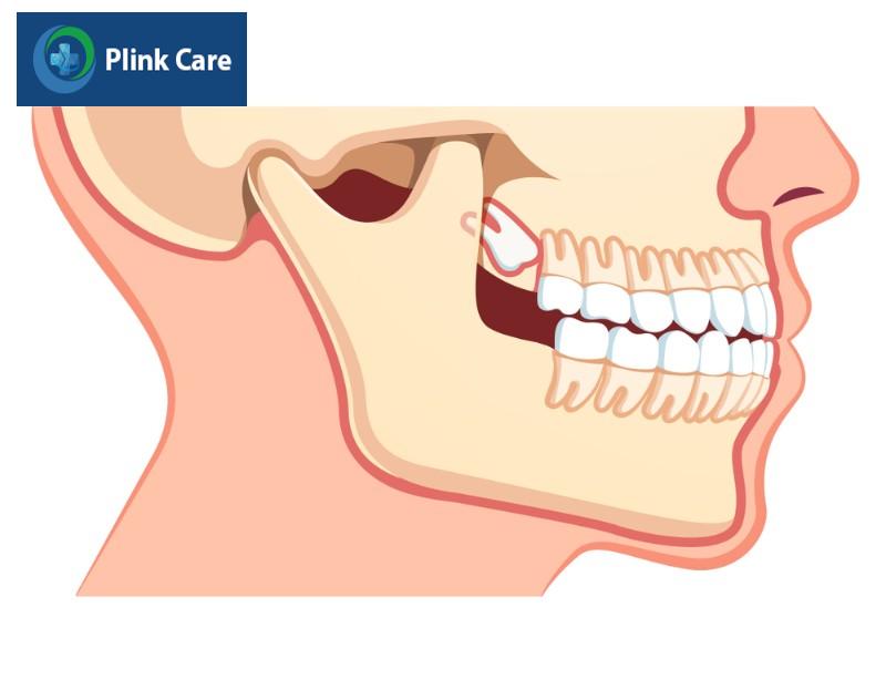 Trường hợp không nên nhổ răng số 8 hàm trên