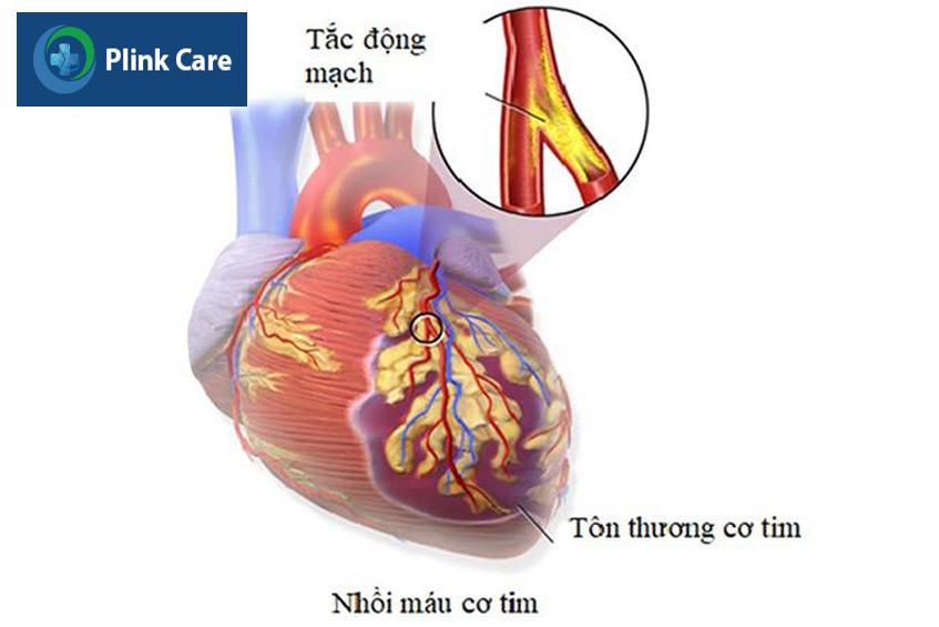 Nhồi máu cơ tim ở người trẻ gây ra nhiều biến chứng nguy hiểm
