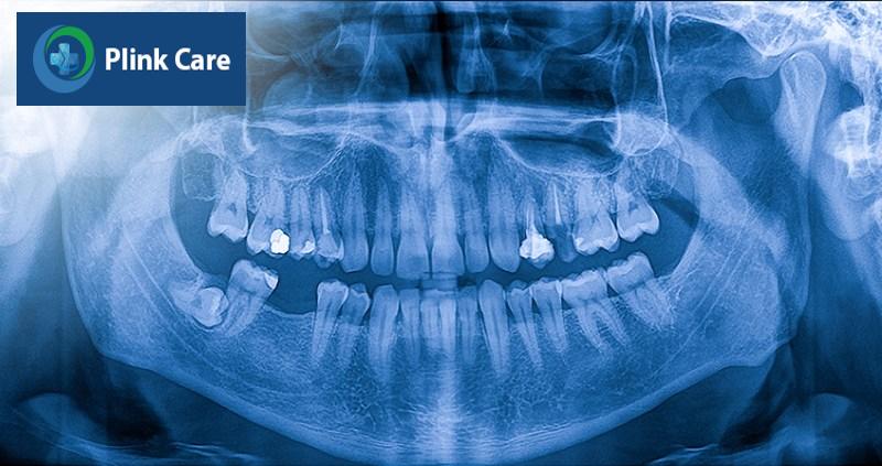 Quy trình nhổ răng sâu tại PlinkCare