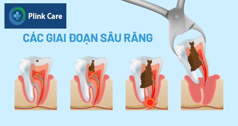 Có nên nhổ răng sâu không?