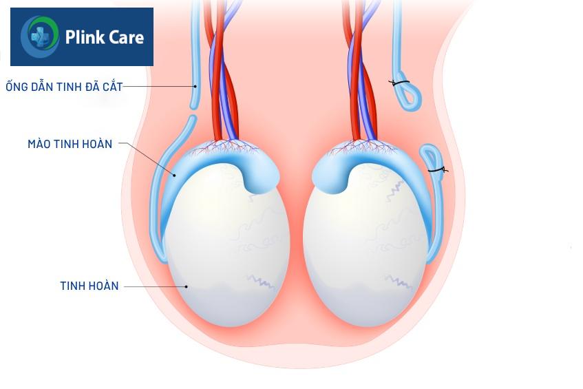 quy trình triệt sản nam