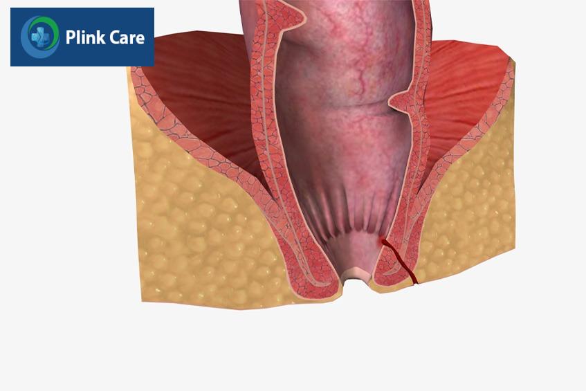 bệnh rò hậu môn có nguy hiểm