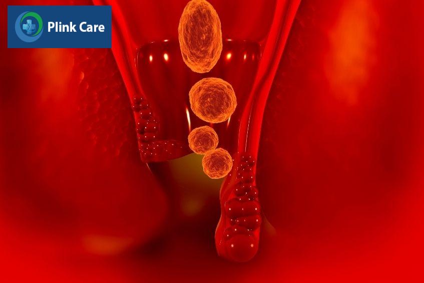 rò hậu môn tái phát sau phẫu thuật